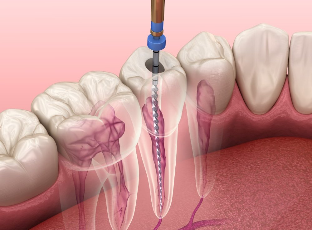 Root Canal
